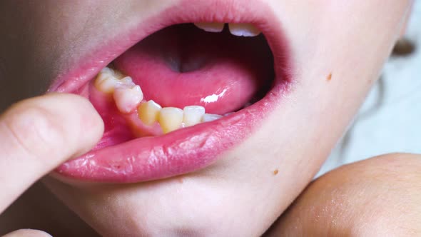 Macro of child trying to remove shaky baby tooth