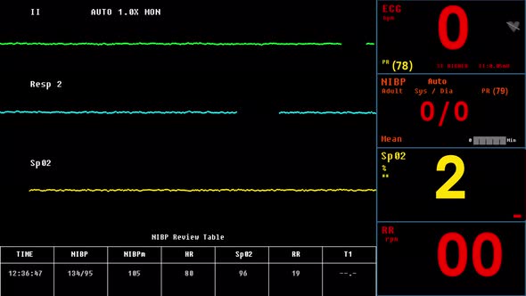 Lines On Cardiology Equipment Monitor Showing Signs Of Patients Heart Stop alt