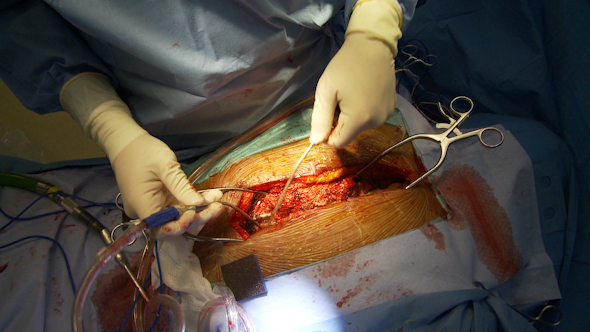 Spinal Surgical Procedure (1 Of 3)