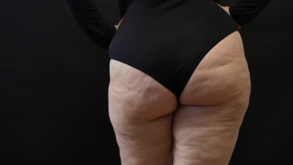 Fat Woman with Cellulite on Her Legs on a Black Background