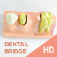3 Crowns Dental Bridge Educational Model - VideoHive Item for Sale