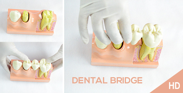 3 Crowns Dental Bridge Educational Model