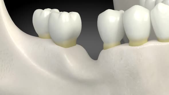 Implant And Crown Installation Process.