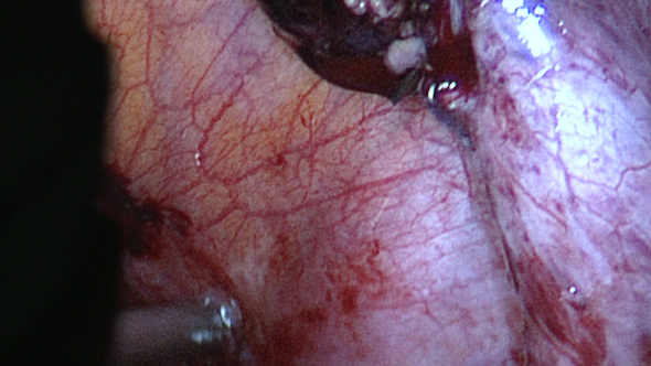 A Seriously Infected Appendix (6 Of 6)