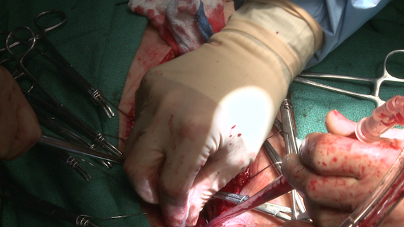 Blood Being Suctioned During Heart Surgery