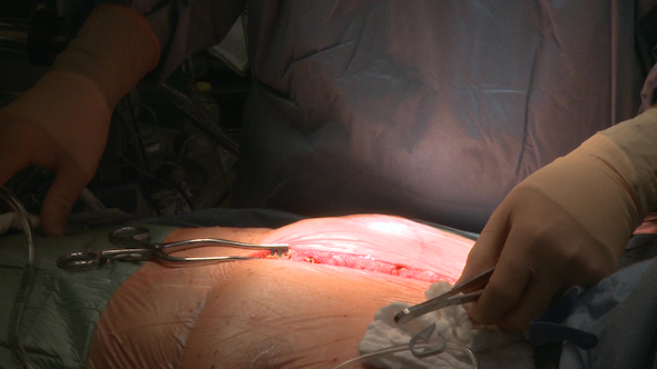 Surgeon Uses Sternum Saw During Open Heart Surgery