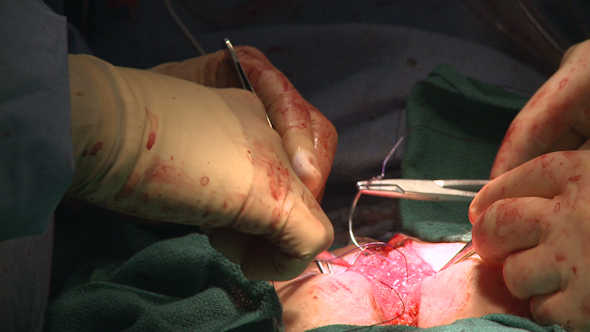 Surgeon Stitching Up Abdomen (8 Of 14)