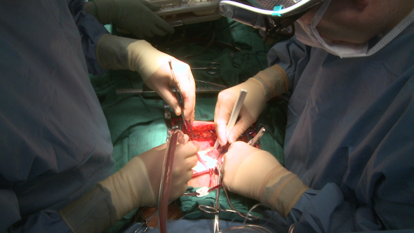 Surgeons Work Together On Heart Patient (11 Of 12)