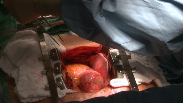 Heart Beats Through Open Chest During Surgery (5 Of 9)