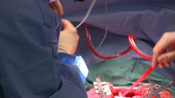 Cell-Salvage Being Used During Aortic Aneurysm Surgery