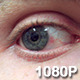 Blue Eye with Mild Nodular Episcleritis - VideoHive Item for Sale