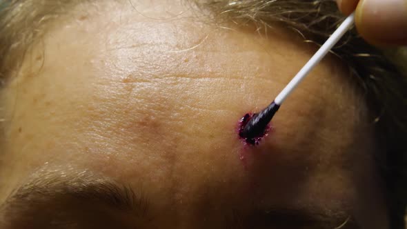 Close-up of a woman's forehead with a fresh wound after a mole remova