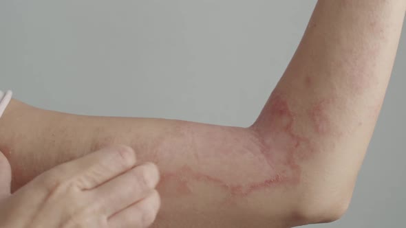 Woman Scratches Her Arm with Dermatitis