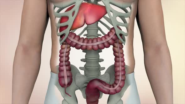 Colon during a enteroscopy with a intestinal or bowel cancer tumor visible.