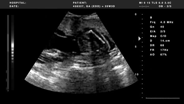 Ultrasound Black And White 5 6