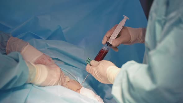 Syringe with blood in doctor's hand. Specialist making stem cells injection to a patient. Close-up.