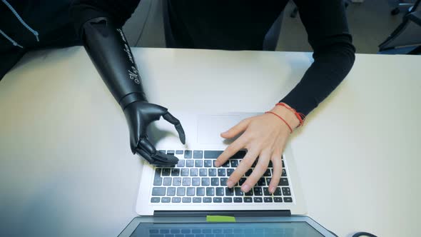 Man with Artificial Hand Types on a Laptop. Cyborg Concept