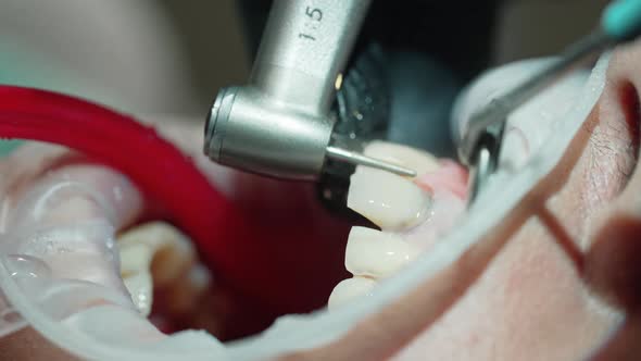 Dentist taking care of painful tooth. Woman on the operation in the dental office