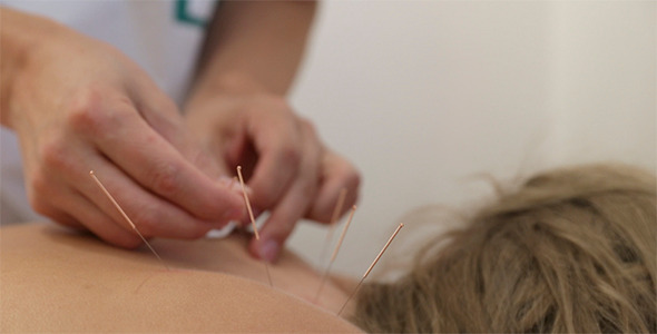 Treatment by Acupuncture alt
