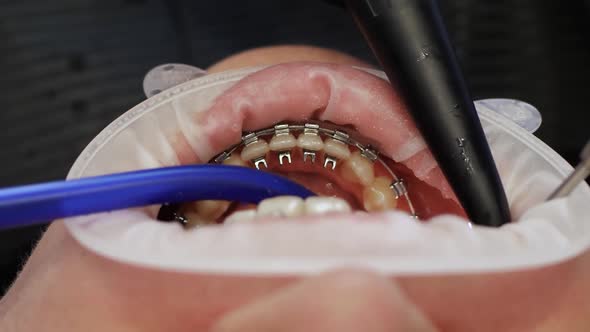 Unrecognizable Patient with Braces