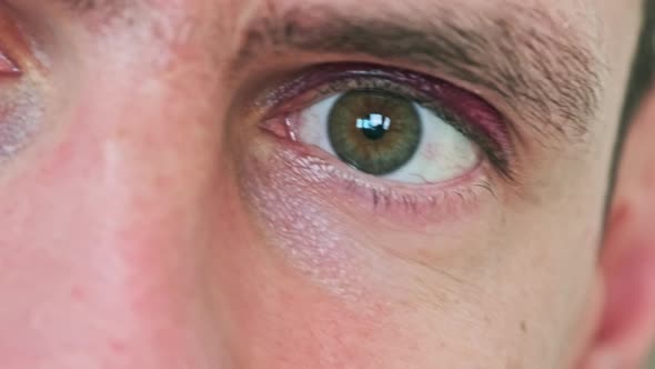 Bruise Over the Eye of a Man Closeup