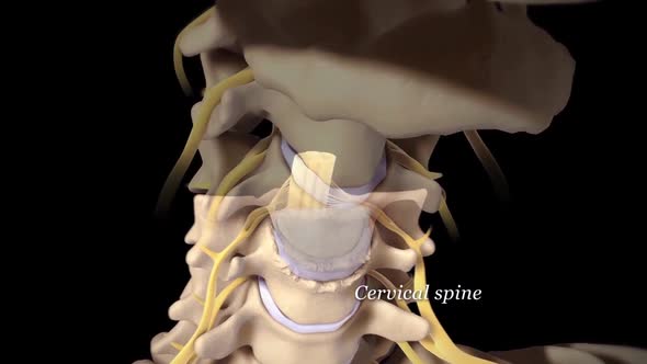 A spinal disc herniation is an injury to the cushioning and connective tissue between the vertebrae.