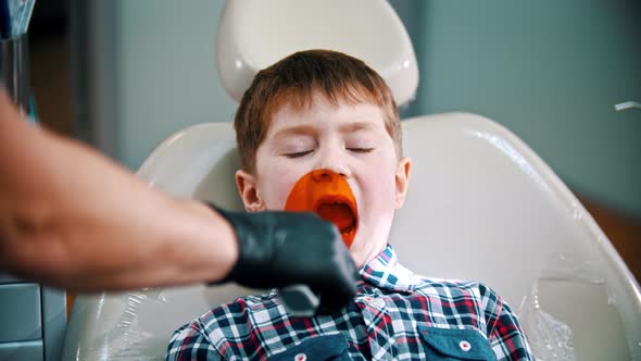 A Little Boy Having His Tooth Done - Putting the Photopolymer Lamp in the Mouth