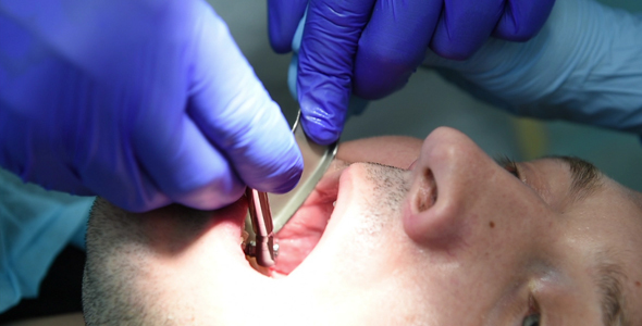 Dental Implantation Procedure