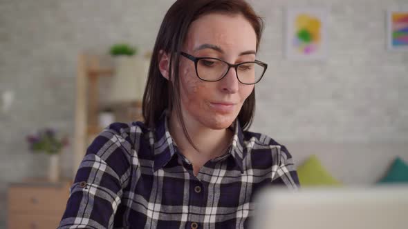 Close Up Young Woman with a Scar From a Burn on Her Face Uses a Laptop