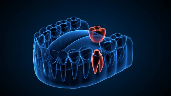 Jaw with implants supporting dental bridge with x-ray effect over dark blue background