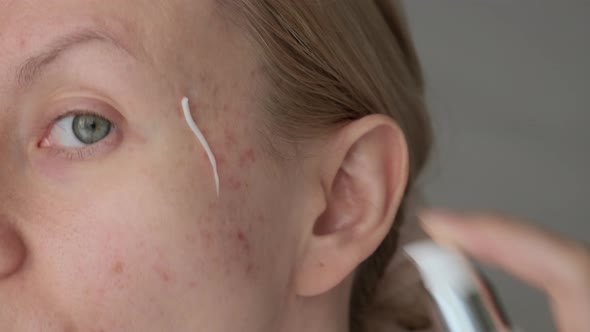 Woman Applying Treatment on Acne Skin