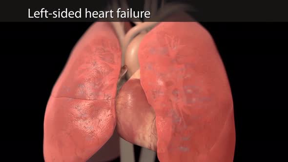 Left-sided heart failure 3d medical