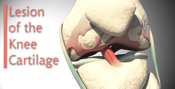 Lesion Of The Knee Cartilage