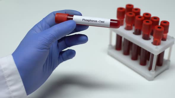 Phosphorus Test, Doctor Showing Blood Sample in Tube, Lab Research, Health Check