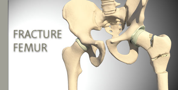 Fracture Femur