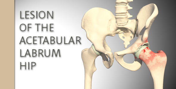 Lesion Of The Acetabular Labrum Hip