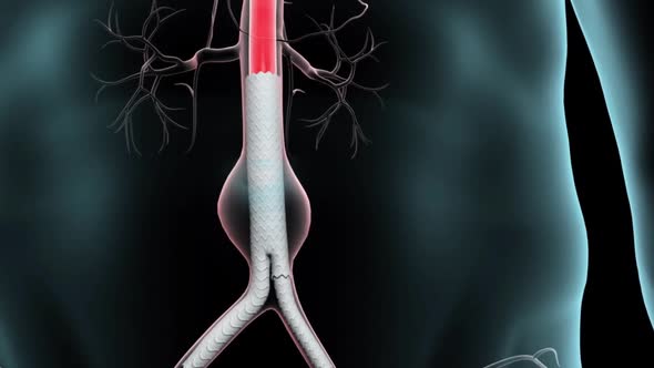 Endovascular Abdominal Aortic Aneurysm Repair