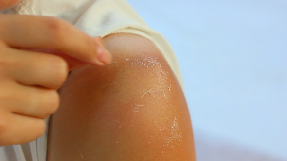 Woman Peeling Irritated Skin From Her Shoulder