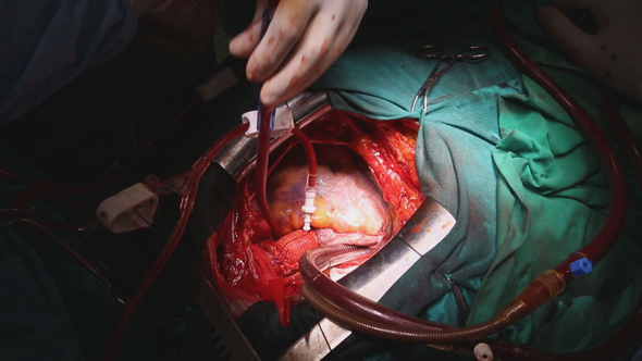 Beating Heart During Heart Surgery