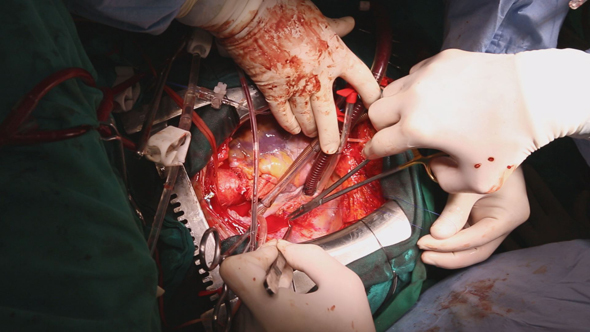 Heart Surgery