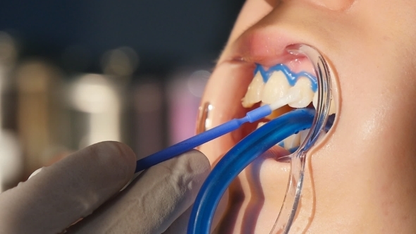 Whitening Teeth  In  alt