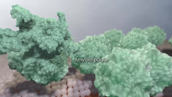 Amyloid Plaques. The beta-amyloid protein involved in Alzheimer's disease