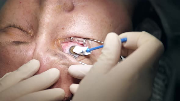 Patient is Getting His Eye Wiped During Surgery