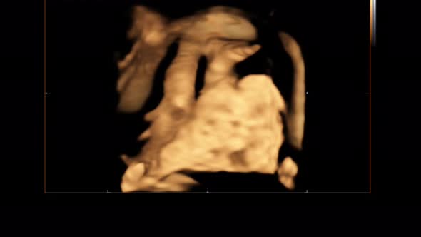 Motion of 4D Ultrasound Echography of Baby Un Mother's Womb