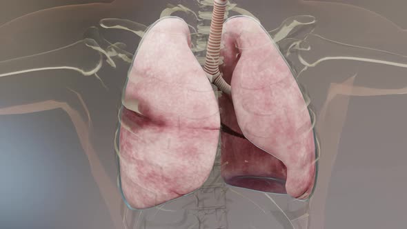 Pneumothorax, Normal lung versus collapsed,  symptoms of pneumothorax