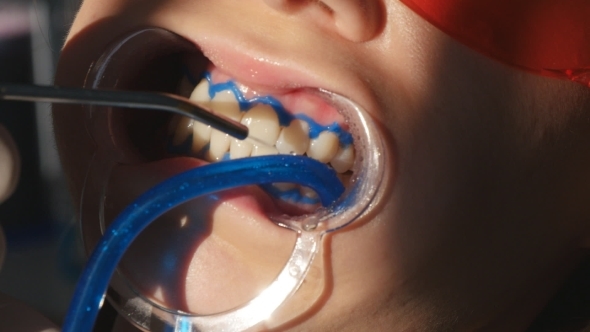 Whitening Teeth In Dental Clinic alt