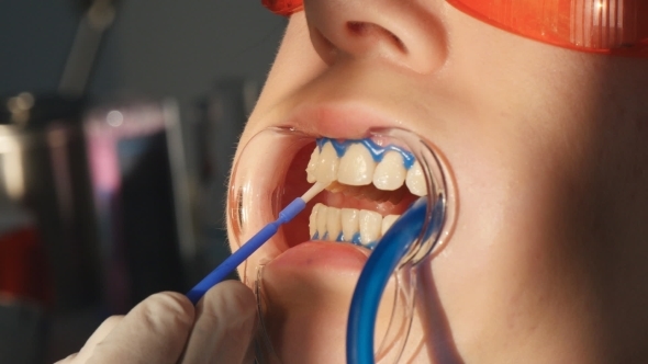 Whitening Teeth In Dental Clinic alt