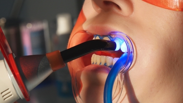 Dentist Working With Dental Polymerization Lamp In Oral Cavity.