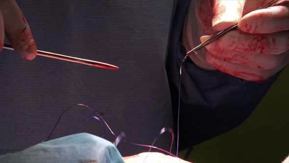 Surgical Suture Or Stitches 4