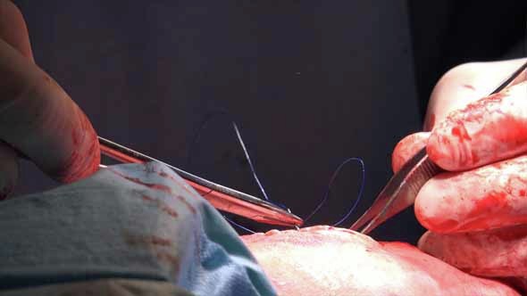 Surgical Suture Or Stitches 10